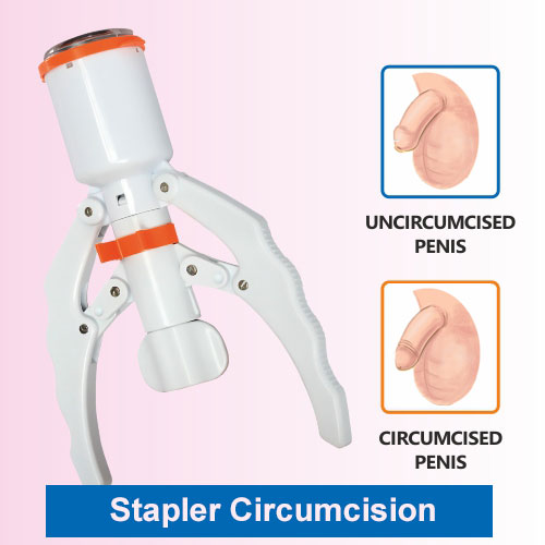 Stapler circumcision