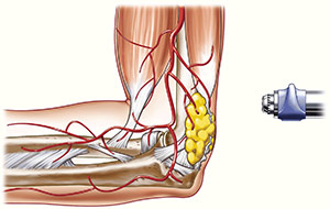 Chronic-Pain-Management