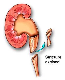 Laparoscopic Pyeloplasty