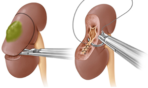 Robotic / Laparoscopic Partial Nephrectomy