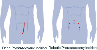 Robotic Prostatectomy