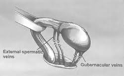 Varicocelectomy