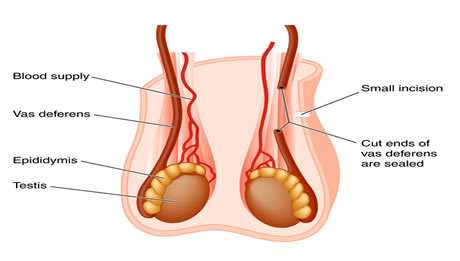 Vasectomy