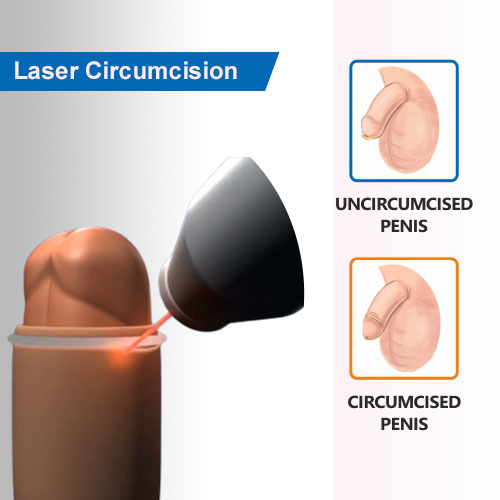 Laser circumcision